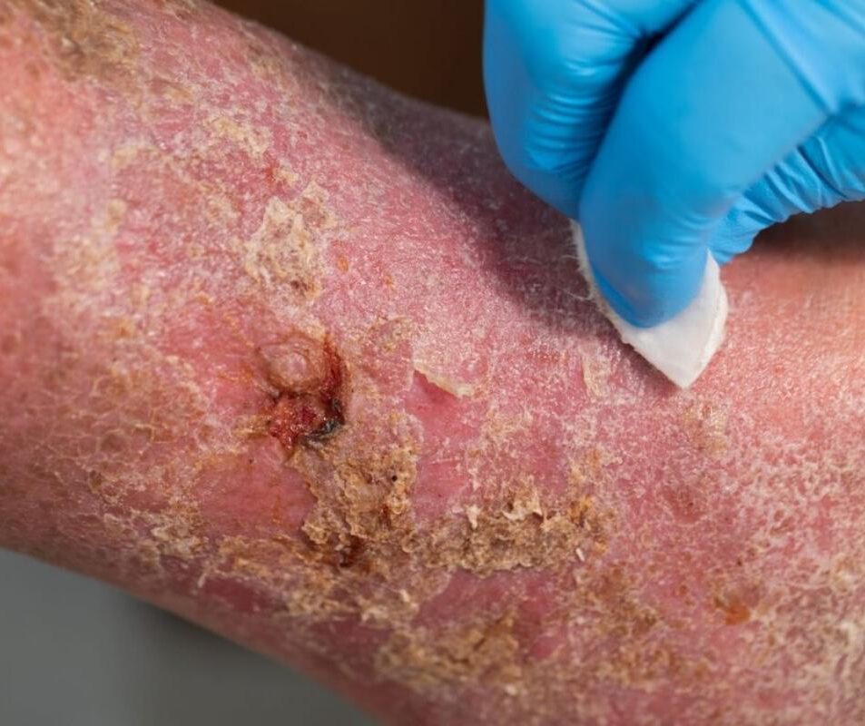 689c8f94f31ba2654f3e06cf_623b770bd88ea26e61c1fd39_Arterial vs. Venous Ulcers- What Is the Difference_