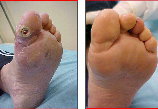 Plantar-region-of-the-thumb-of-a-diabetic-patient-with-osteomyelitis-pre-and-post